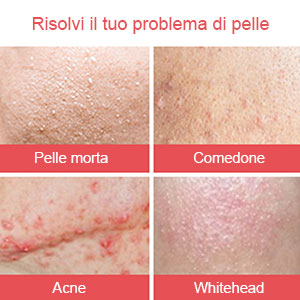 Ultrasonic Skin Scrubber Ultrasuoni Viso Pulizia Face Skin Peeling (IN OMAGGIO 1 CREMA EFFETTO LIFTING+1 CREMA IDRATANTE VISO)